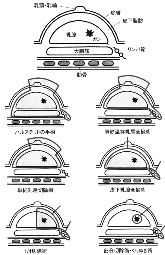 乳がんの様々な手術法（図）